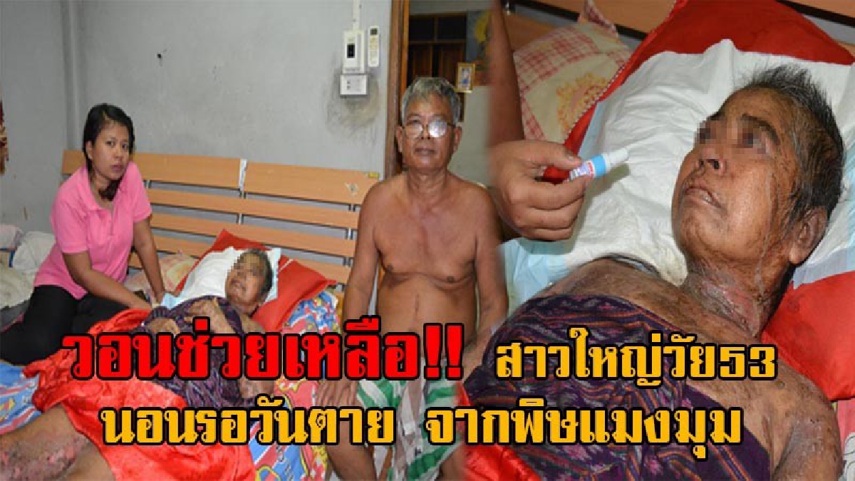 สุดเวทนา!! สาวใหญ่วัย53 โดนแมงมุมแม่ม่ายกัด พิษกระจายจนเน่าเฟะทั้งร่าง ทุกข์ทรมานอย่างแสนสาหัส นอนรอวันตาย เผยพบเพียง 1 ในล้านเท่านั้น