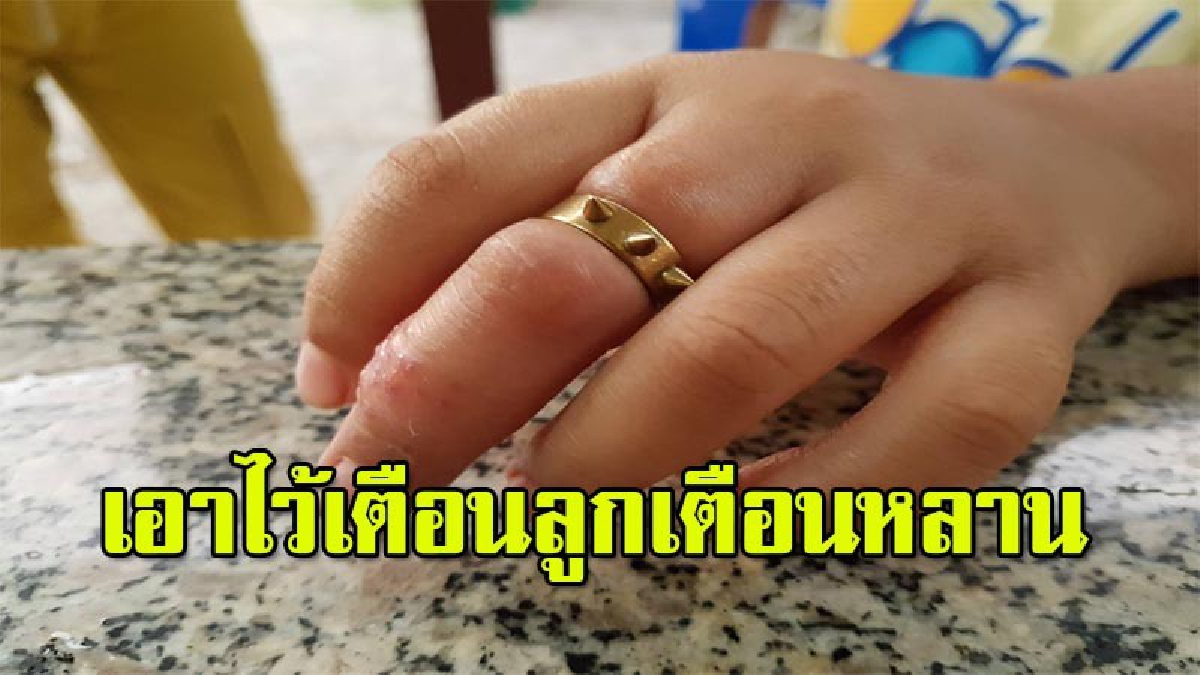 อุทาหรณ์..อย่าสักแต่ว่าเท่!! เด็กป.4 ซื้อแหวนมาใส่ ติดแน่นถอดไม่ออก รัดนิ้วจนบวมเป่ง ทรมานอยู่ 2วัน ถึงมือกู้ภัยฯต้องช่วยตัด (มีคลิป)
