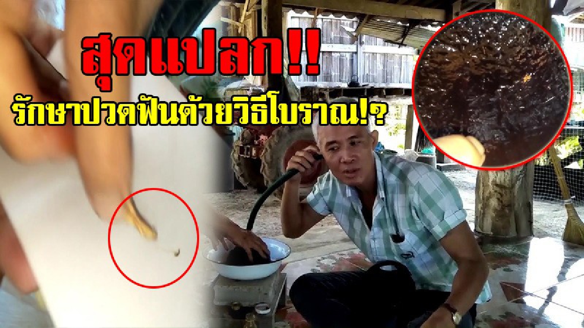 เผยวิธีรักษาโคตรแปลก!? ใครที่ปวดฟันหนัก ฟังทางนี้ มีวิธีโบราณรักษาอาการ "ปวดฟัน" หายเป็นปลิดทิ้ง แถมมีตัวการวิ่งหนีเผ่นตายออกมาให้เห็นชัดๆ!?