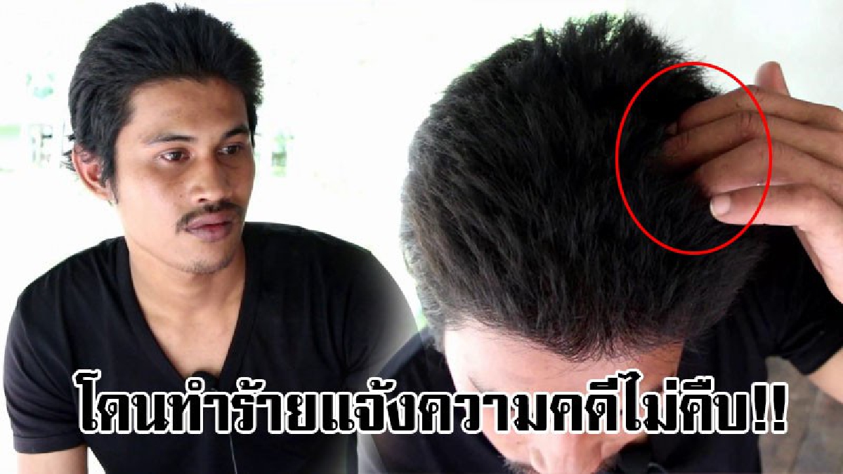 #ช่วยคนจนด้วย..!! หนุ่มวัย25 เข้าร้องสื่อ กรณีโดนวัยรุ่นแถวบ้านตีหัว ทำร้ายร่างกาย แจ้งความแล้วแต่เรื่องยังเงียบนาน 2 ปี ตอนนี้ผวาตลอดเวลา!?