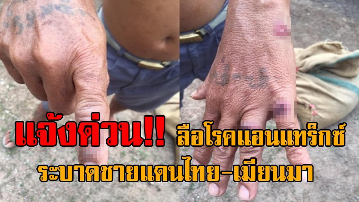 ด่วน..!! ลือหึ่ง "โรคแอนแทร็กซ์" ระบาดชายแดนไทย-เมียนมา แพทย์ชี้ยังไม่แน่ชัด เตือนชาวบ้านที่วิตก ควรกินเนื้อสัตว์ที่ปรุงสุกเท่านั้น!? (คลิป)