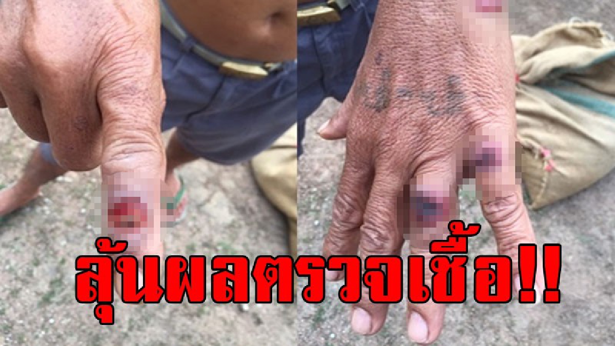 จนท.สั่งชะลอนำเข้าสัตว์เท้ากีบจากเมียนมา..!! หลังพบผู้ติดเชื้อคล้ายเป็น "โรคแอนแทรกซ์" 3 ราย ลุ้นผลตรวจเชื้อเป็นเพราะอะไร..!?