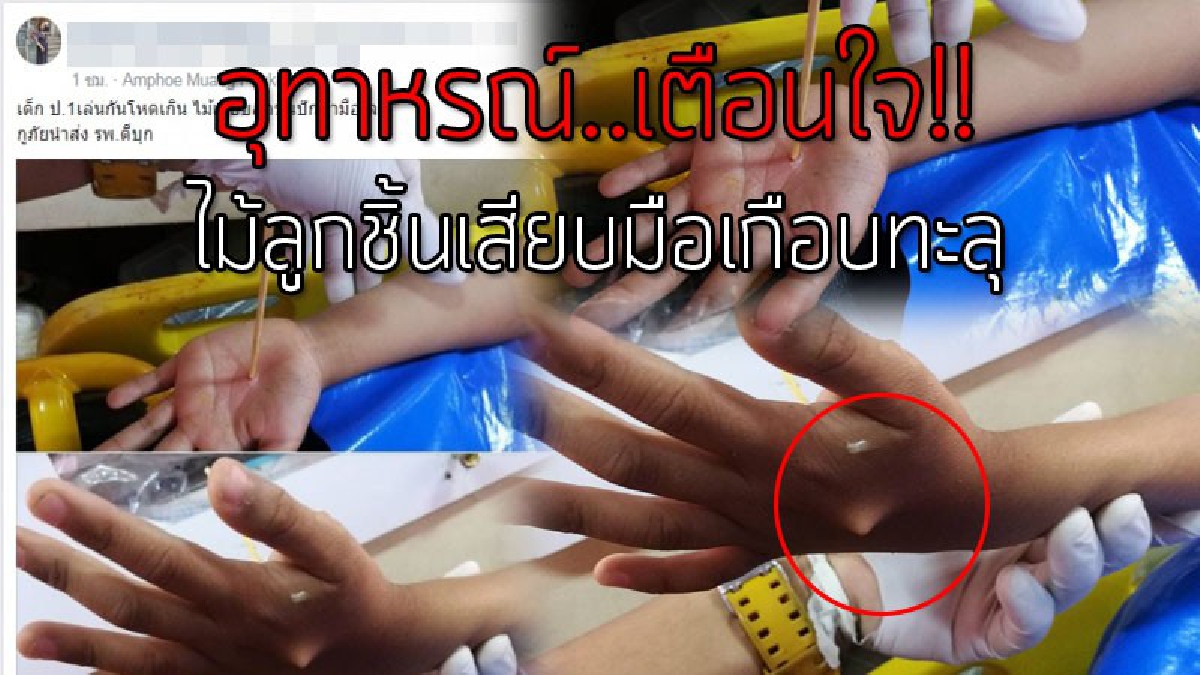 เล่นกันโหดมาก!? ภาพสุดหวาดเสียว ทำพ่อแม่แทบช็อก เมื่อเด็ก ป.1 โรงเรียนดัง เล่นกับเพื่อนช่วงพักเที่ยง "โดนไม้ลูกชิ้น" เสียบกลางฝ่ามือหวิดทะลุ