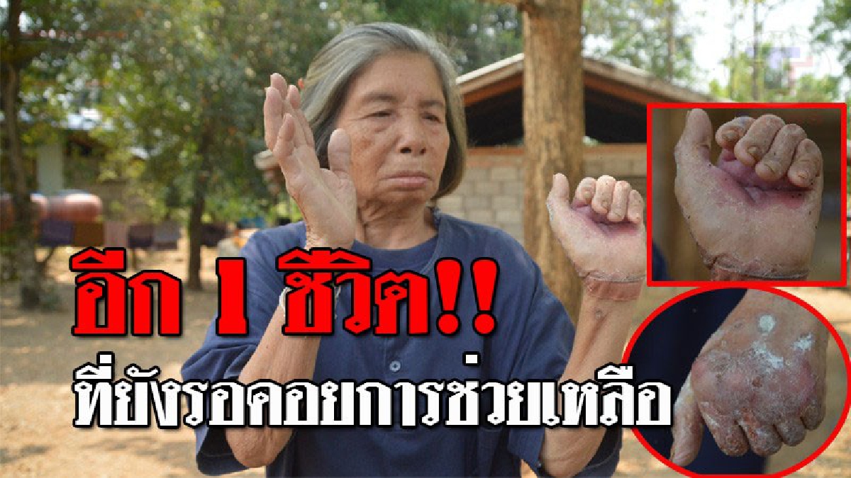 ชีวิตแสนรันทด..!! หญิงชรายากจน เชื้อรากินมือจนมือหงิก อยู่กับลูกมีอาการทางสมอง ต้องเก็บผัก ขอข้าววัดกิน วอนหน่วยงานรัฐช่วยเหลือ!? (ชมคลิป)