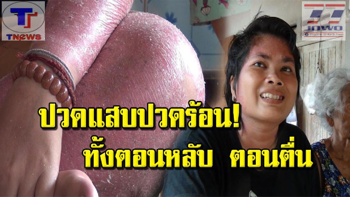 ทรมานมาแสนนาน !! สุดเวทนา สาวป่วยโรคสะเก็ดเงินลุกลามทั่วทั้งตัว วอนช่วยเหลือ..แม่พูดทั้งน้ำตา "ไม่เงินจะพาลูกไปรักษาแล้ว" (คลิป)