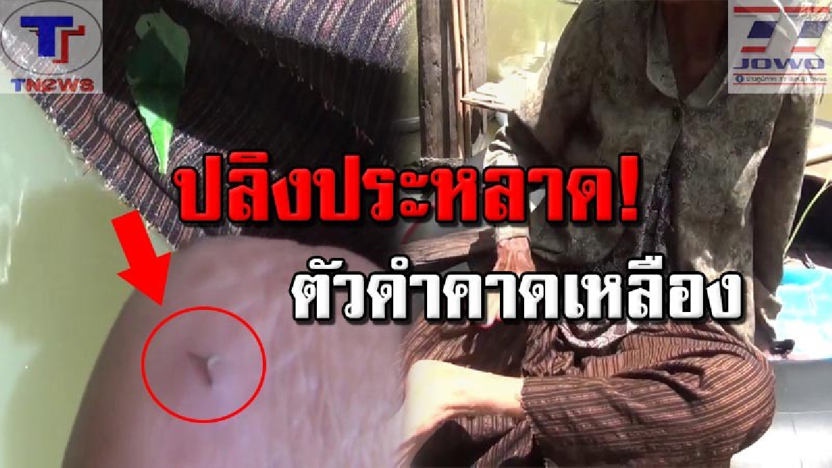 โผล่อีกแล้ว "ปลิงประหลาด" !! ยายวัย 80 ปีผวา..ถูกกัด ขณะเก็บดอกหญ้า เผยบาดแผลเป็นรูปสามแฉก มีเลือดไหลออกมากและบวมช้ำ (คลิป)