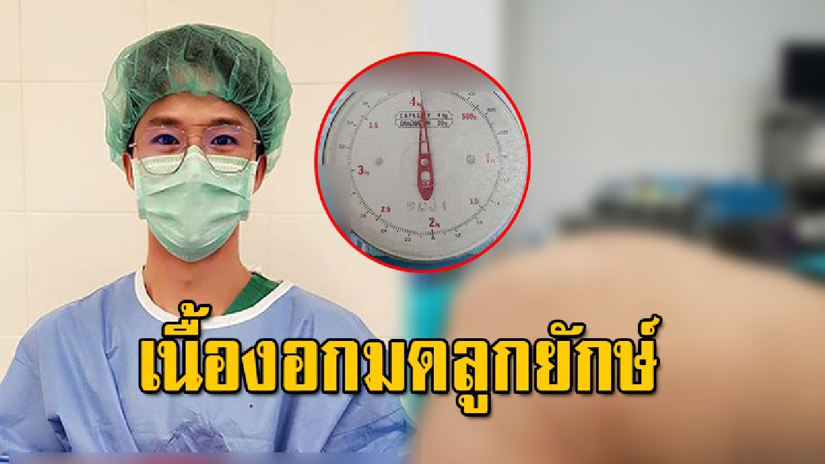 สาวใหญ่วัย40 เข้าผ่าตัดมดลูก เจอเนื้องอกยักษ์ ขนาดเท่าการตั้งครรภ์ 8 เดือน