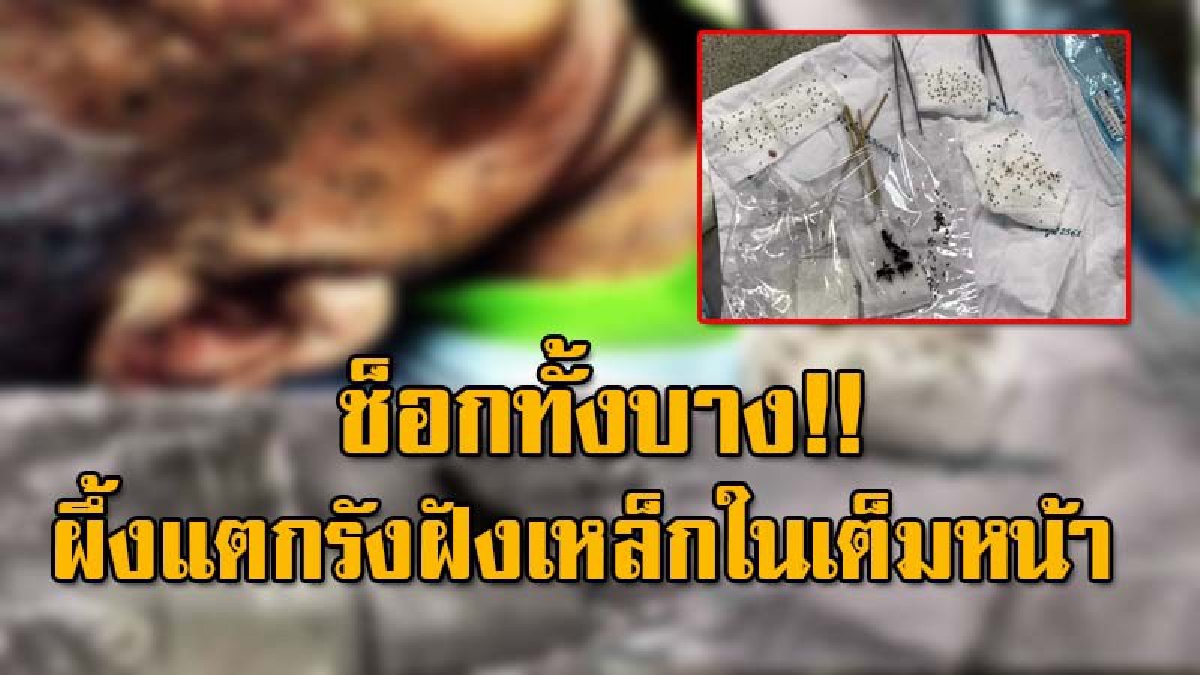 พ่อเฒ่าวัย 85 โดนฝูงผึ้งรุมต่อย ฝังเหล็กในเต็มใบหน้า