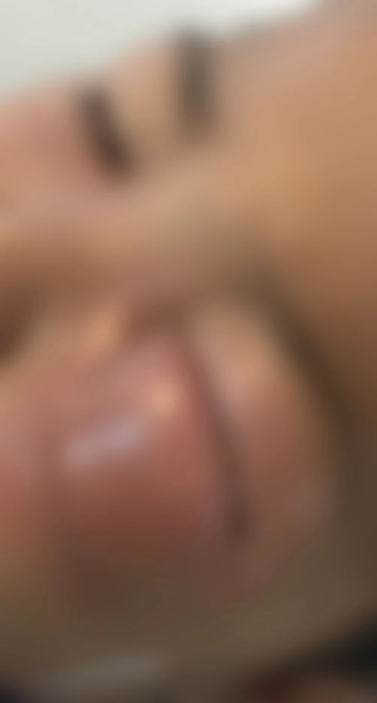 หนูน้อย 3 ขวบ ฟันผุทั้งปาก จนตาปิดไปข้าง