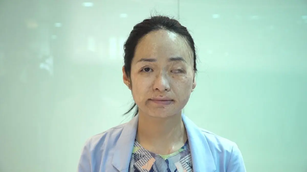 สาวโดนน้ำกรดสาด หน้าเสียโฉมหนัก ล่าสุด "น้องฉัตร" จัดเมคอัพแปลงโฉม จนกลับมาสวยเหมือนได้ชีวิตใหม่