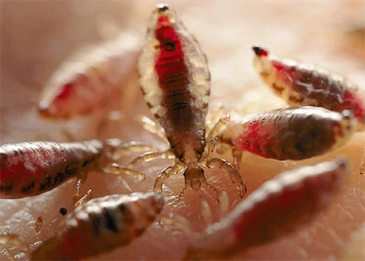 ทำครั้งเดียวหายเกลี้ยง!! เผยสูตรเด็ดเคล็ดลับ วิธีกำจัด "เหา" "แบบหายขาด" โดยที่แพทย์ไม่บอกคุณ ไม่ต้องโกนหัวทิ้งอีกต่อไป!!!! (แชร์เก็บไว้เลย)