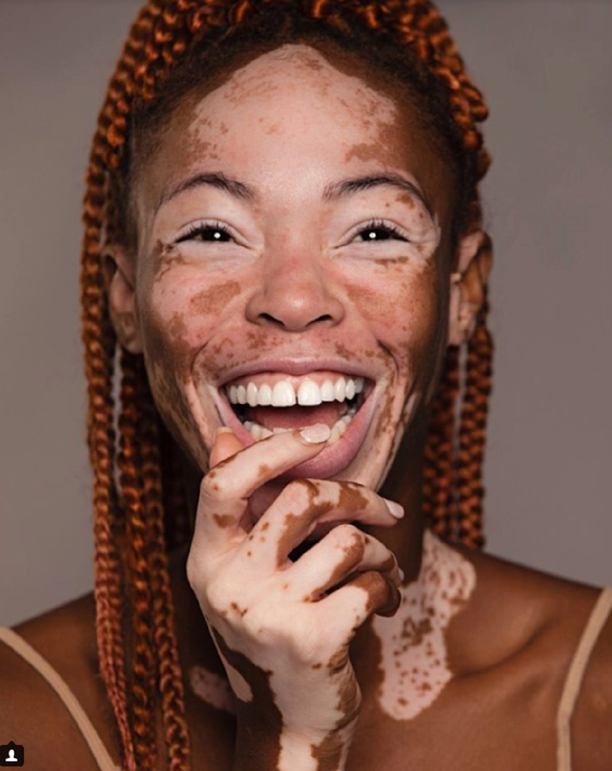 *ขยี้ตารัวๆ!!! เปิดภาพหญิงสาวหน้าแปลก ถูกตราหน้าว่าไม่สวย แต่ทุกวันนี้เธอคือนางแบบมืออาชีพที่ดังไปทั่วโลก!!! (คลิป)