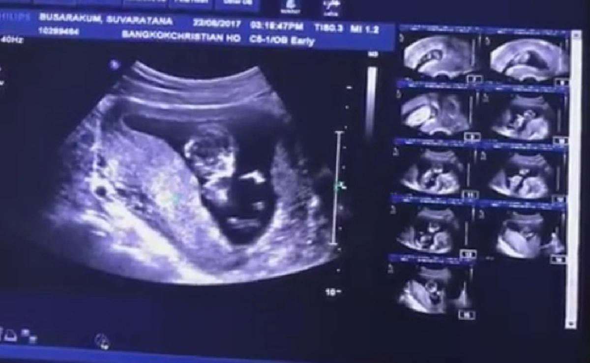 เปิดปุ๊บติดปั๊บ!!! "เอ็ม บุษราคัม"  ลูกสาว"หม่ำ จ๊กมก" โพสต์IGสุดตื่นเต้นตั้งครรภ์ลูกคนเเรก ทำครอบครัววงษ์คำเหลาเฮลั่นบ้าน!??