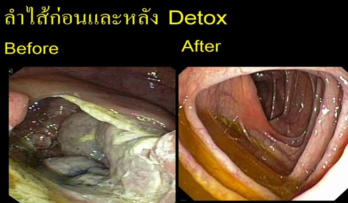 อยากสุขภาพดีต้องดู!!! รวม 4 สูตรดีท็อกซ์ล้างลำไส้ ดื่มแล้วไร้สิว พุงยุบตัวเบาหวิว หน้าท้องลด ใน 3 วันโดยไม่ต้องพึ่งยา รู้แล้วรีบแชร์ด่วน