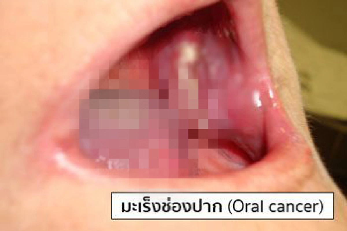 อย่าชะล่าใจ!!! ระวังเสี่ยงมะเร็งช่องปากโดยไม่รู้ตัว เช็คด่วนคุณคือหนึ่งไหนกลุ่มเสี่ยงหรือไม่!!!