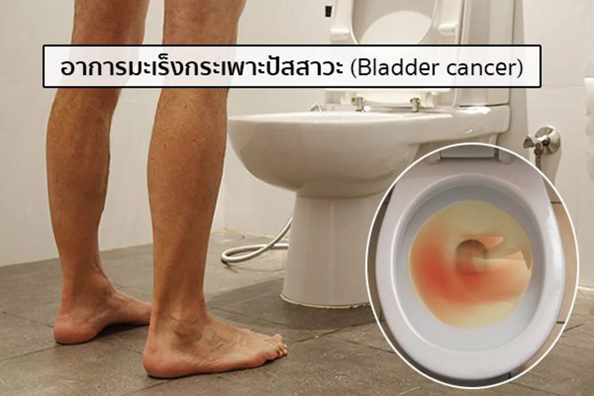 แพทย์ย้ำ!!! มะเร็งกระเพาะปัสสาวะพบบ่อยในไทย ไม่มีปัจจัยเสี่ยงก็เกิดโรคได้!!!