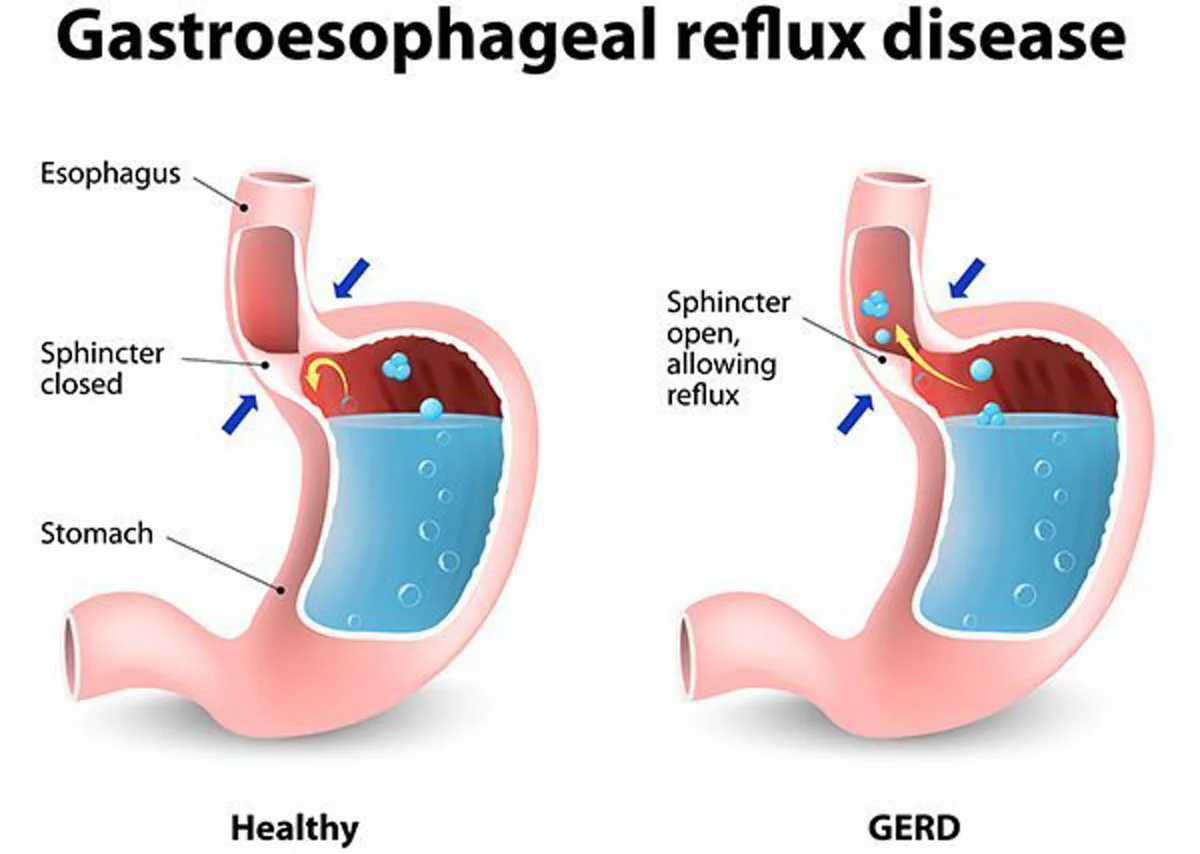 มนุษย์เงินเดือนต้องรู้!!! “โรคกระเพาะกรดไหลย้อน” ภัยเงียบโรคออฟฟิศซินโดรมสำหรับคนทำงานยุคนี้