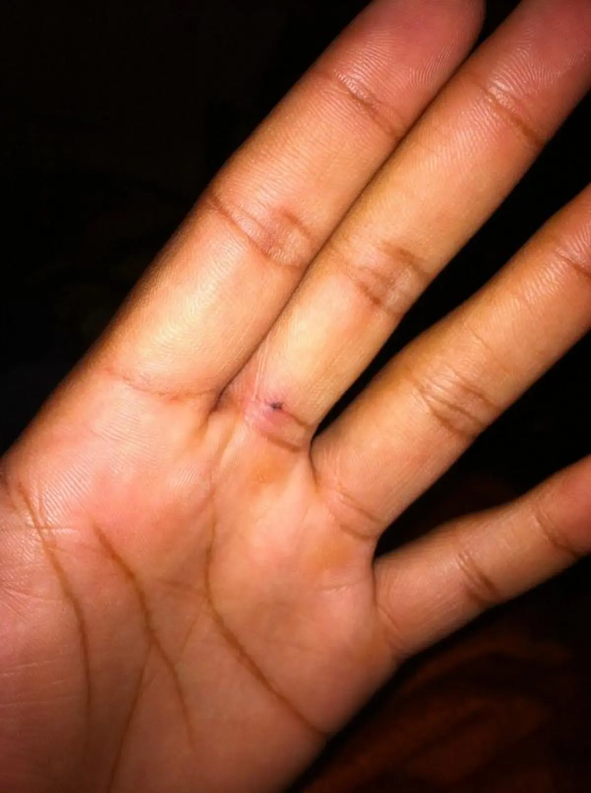 ชาวเน็ตแชร์รูป รอยสักที่เกิดจากการ โดนดินสอทิ่ม และมันยังติดตัวเราจนถึงทุกวันนี้