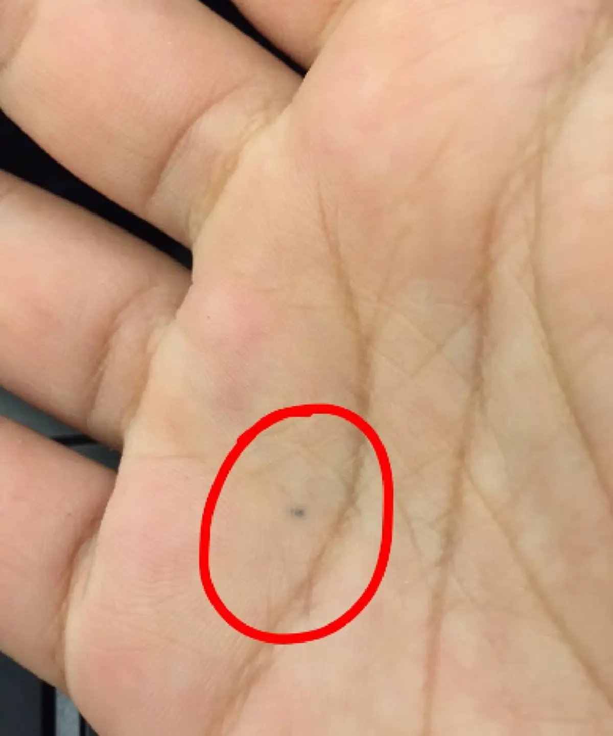 ชาวเน็ตแชร์รูป รอยสักที่เกิดจากการ โดนดินสอทิ่ม และมันยังติดตัวเราจนถึงทุกวันนี้