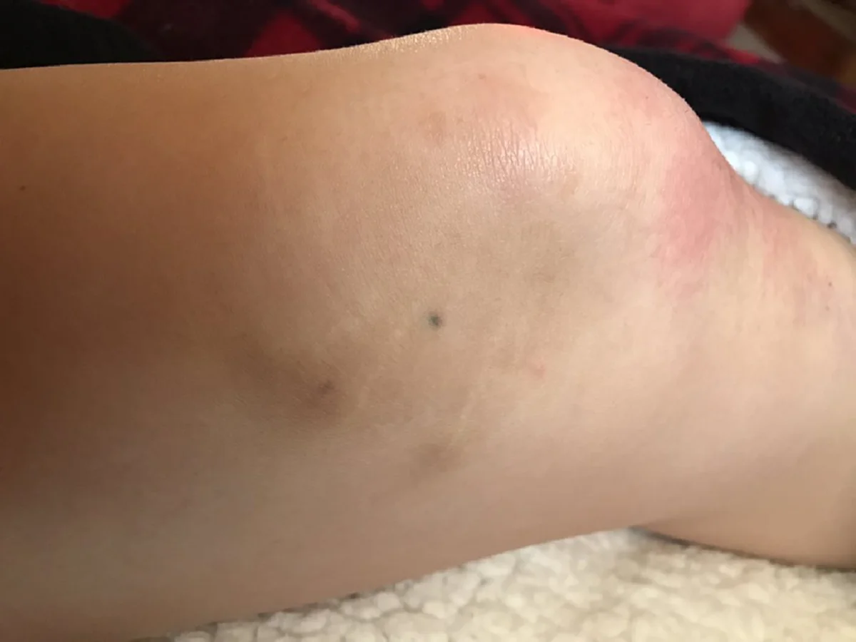 ชาวเน็ตแชร์รูป รอยสักที่เกิดจากการ โดนดินสอทิ่ม และมันยังติดตัวเราจนถึงทุกวันนี้