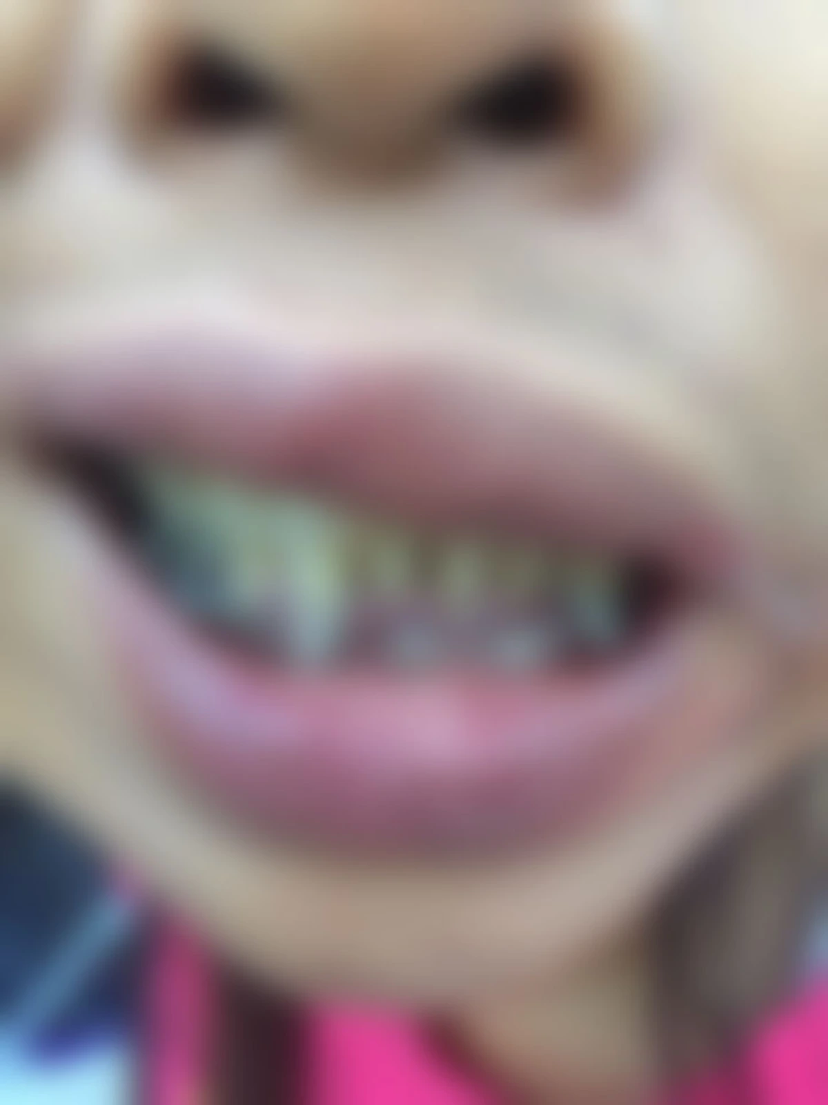 สาวเกิดอุบัติเหตุ กระจกเข้าตา โร่หา "หมอ" แต่สุดท้ายแค่เย็บแผลให้