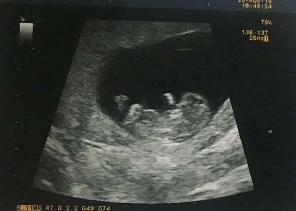 สตรองสุดๆ "หนูเล็ก ก่อนบ่าย" น้ำตาซึม หลังรู้อาการลูกน้อยในครรภ์ครั้งแรก แทบลืมความทรมานแม้ต้องแพ้ท้องหนัก