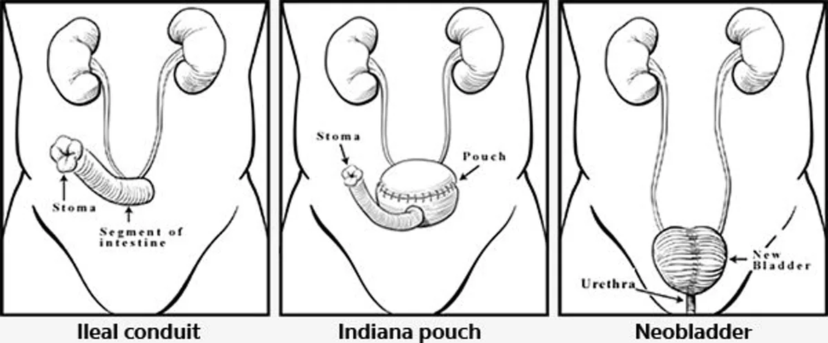 แพทย์ย้ำ!!! มะเร็งกระเพาะปัสสาวะพบบ่อยในไทย ไม่มีปัจจัยเสี่ยงก็เกิดโรคได้!!!