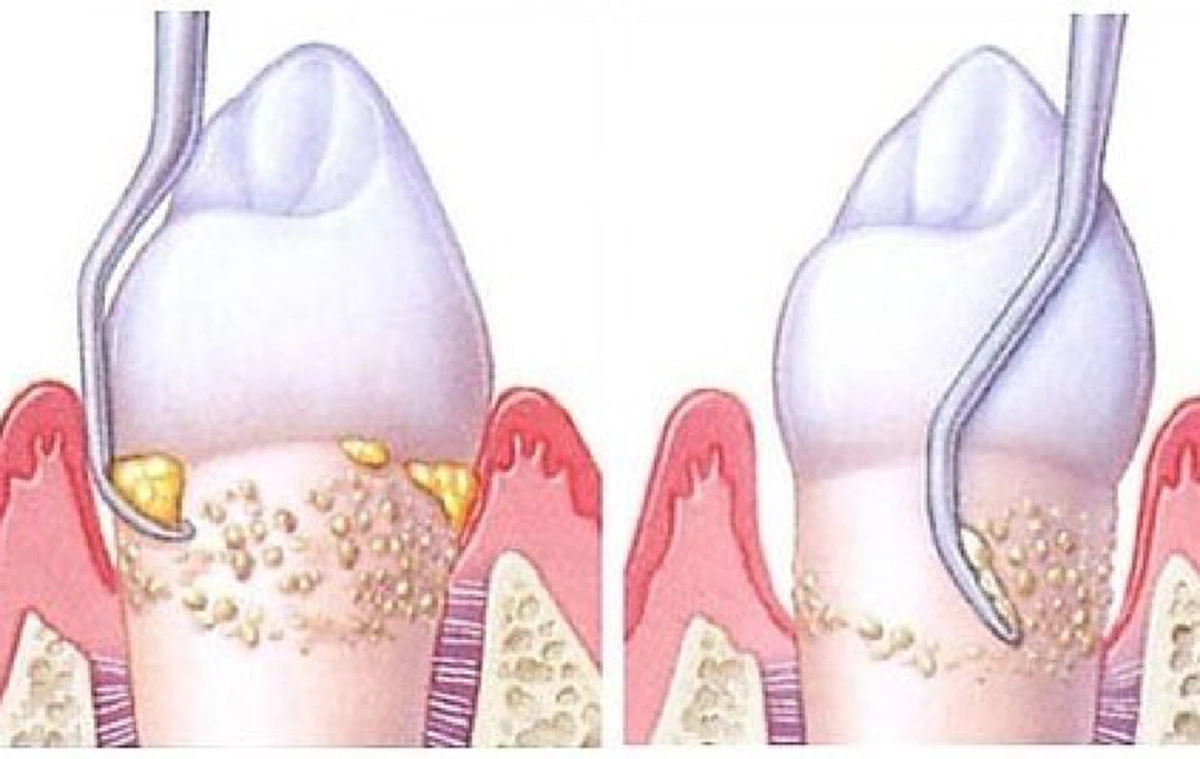 โง่มาตั้งนาน!!! เผยเคล็ดลับเด็ด วิธีกำจัดฟันเหลือง ให้ขาวสะอาดทันตาเห็น ไม่อยากเสียความมั่นใจอ่านด่วน!!!