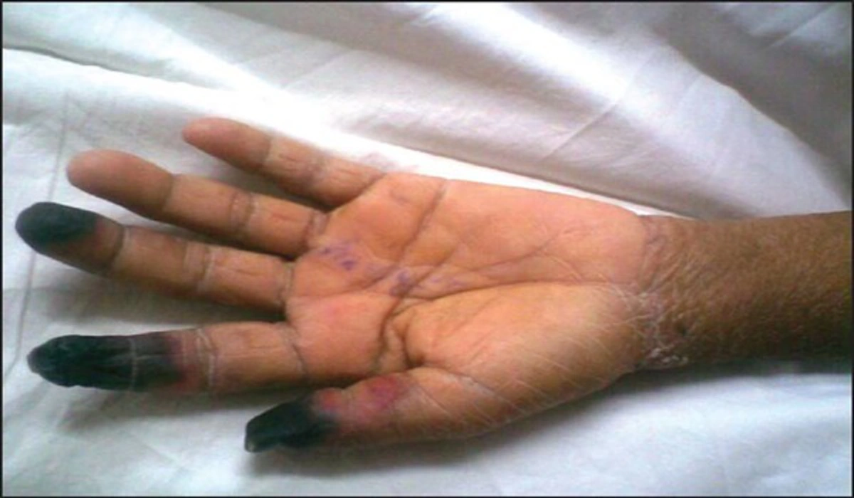 ใครปวดหัวข้างเดียวต้องระวัง!!! ไขความรู้ ยาคู่มรณะ กินผิดอาจจบชีวิตได้