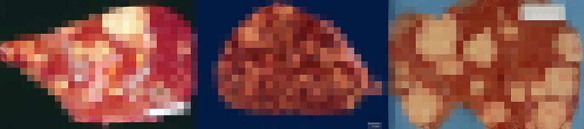 เตือนภัยมะเร็งตับลุกลามเร็ว!!! 10 สัญญาณเตือนโรคมะเร็งตับ เช็กก่อนอย่าปล่อยให้มะเร็งตัวร้ายทำลายสุขภาพ?!!!