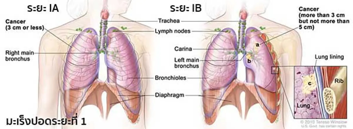 เป็นได้แม้ไม่เสี่ยง!!! เพียงใช้ชีวิตประจำวันผิดๆ คุณก็เสี่ยงเป็นมะเร็งปอดโดยไม่รู้ตัว อ่านก่อน รู้ทัน ป้องกันได้!!!