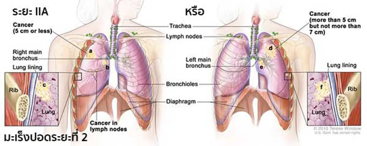 เป็นได้แม้ไม่เสี่ยง!!! เพียงใช้ชีวิตประจำวันผิดๆ คุณก็เสี่ยงเป็นมะเร็งปอดโดยไม่รู้ตัว อ่านก่อน รู้ทัน ป้องกันได้!!!