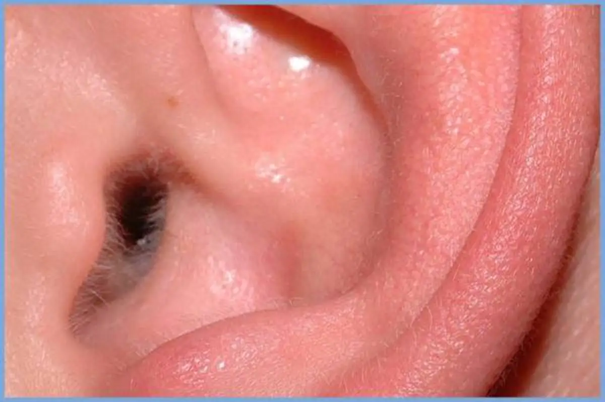 #แพทย์เตือนแล้ว!! "ขี้หู" เปียก-แห้ง แบบไหนกัน ที่เสี่ยงเป็นมะเร็ง อันตรายถึงชีวิต เช็คด่วน! ก่อนจะสายเกินแก้ เอาตัวรอดแทบไม่ทัน !! (ชมคลิป