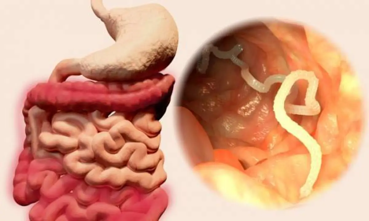 #หายโง่ทันที!! เคล็ดลับสุดเด็ด "กำจัดพยาธิ-ล้างสารพิษ" ในร่างกายด้วย "กระเทียมสด" เห็นผลเกินคาด ลองทำตามดู ได้ผลชัวร์ !! (รายละเอียด)