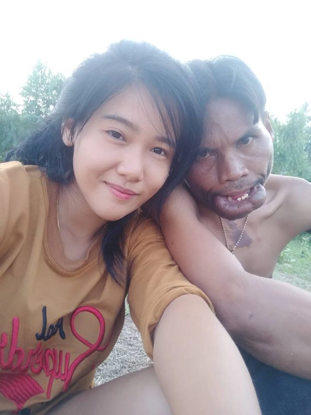 #ใกล้ถึงเวลาได้ชีวิตใหม่!! เปิดภาพล่าสุด “มีมี่ หนุ่มหน้าปาน” หลังขึ้นเขียงผ่าตัดครั้งแรก แฟนคลับแห่คอมเม้นท์สนั่น เตรียมตัวหล่อได้เลย!!