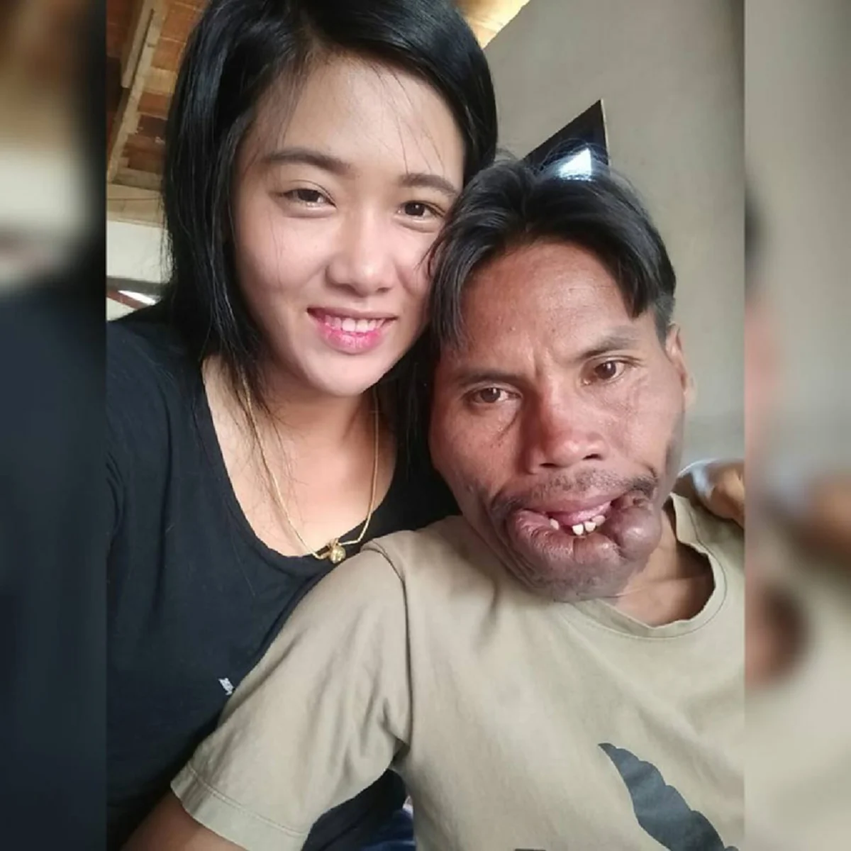 #ใกล้ถึงเวลาได้ชีวิตใหม่!! เปิดภาพล่าสุด “มีมี่ หนุ่มหน้าปาน” หลังขึ้นเขียงผ่าตัดครั้งแรก แฟนคลับแห่คอมเม้นท์สนั่น เตรียมตัวหล่อได้เลย!!