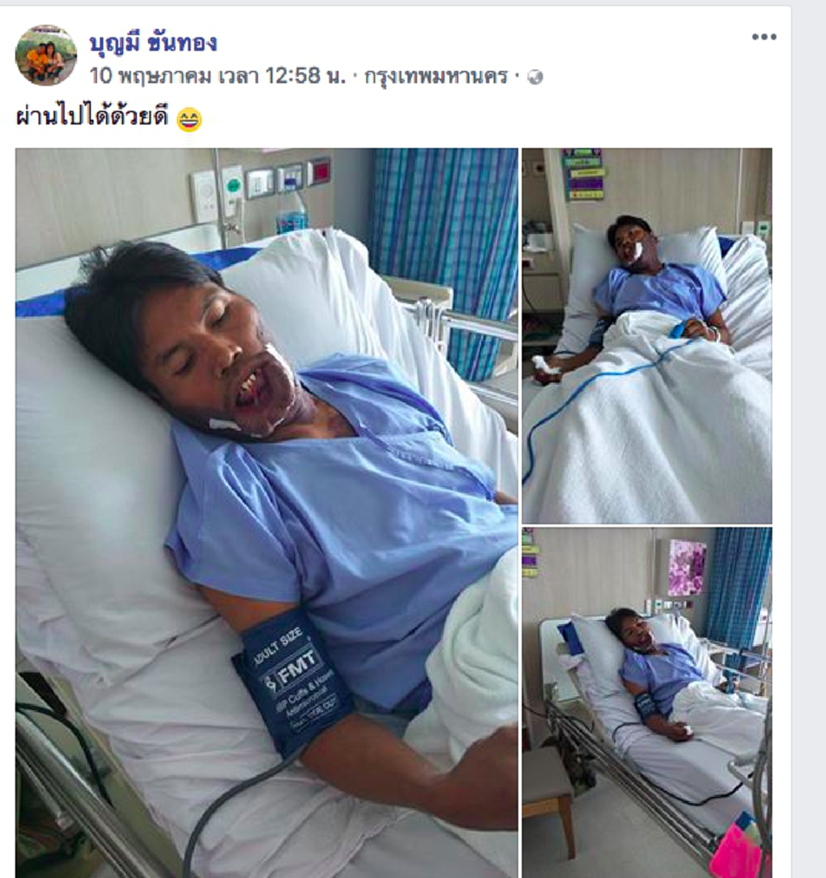 #ใกล้ถึงเวลาได้ชีวิตใหม่!! เปิดภาพล่าสุด “มีมี่ หนุ่มหน้าปาน” หลังขึ้นเขียงผ่าตัดครั้งแรก แฟนคลับแห่คอมเม้นท์สนั่น เตรียมตัวหล่อได้เลย!!