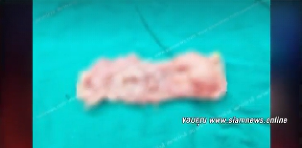 สาวเสริมอกใหญ่เกินตัว หวิดดับ หลังซิลิโคนแตก