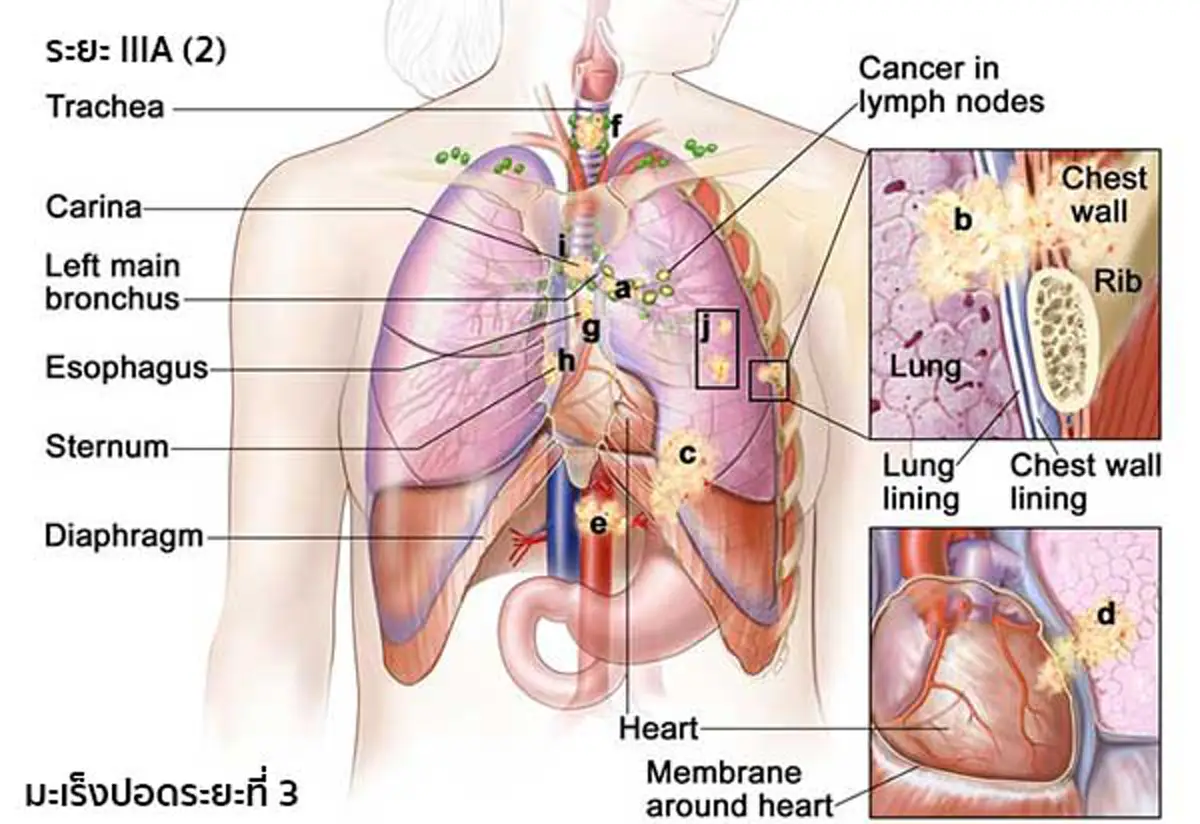 เป็นได้แม้ไม่เสี่ยง!!! เพียงใช้ชีวิตประจำวันผิดๆ คุณก็เสี่ยงเป็นมะเร็งปอดโดยไม่รู้ตัว อ่านก่อน รู้ทัน ป้องกันได้!!!