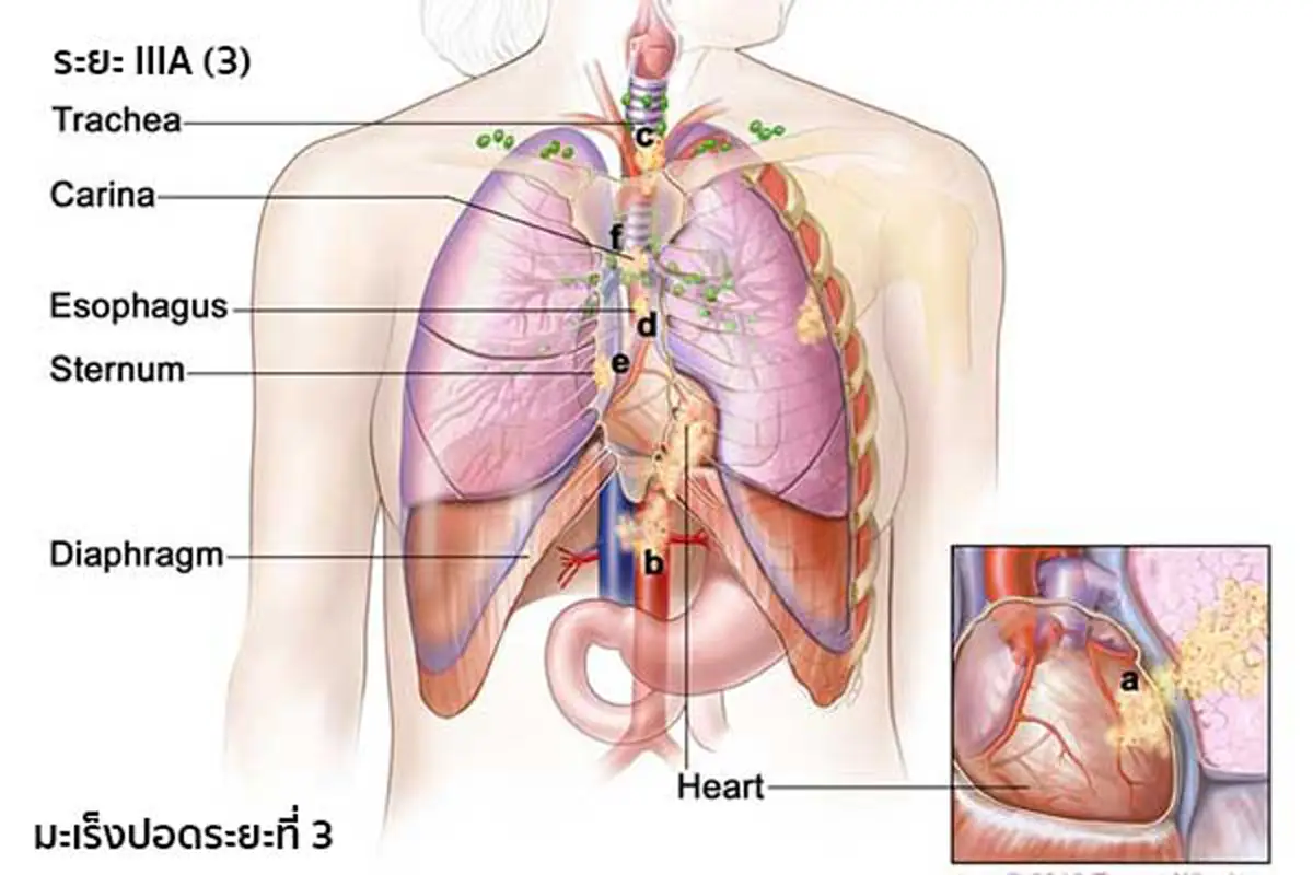 เป็นได้แม้ไม่เสี่ยง!!! เพียงใช้ชีวิตประจำวันผิดๆ คุณก็เสี่ยงเป็นมะเร็งปอดโดยไม่รู้ตัว อ่านก่อน รู้ทัน ป้องกันได้!!!