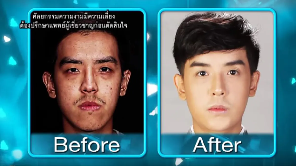 อึ้งตาค้างอย่างแรง!! สองหนุ่มคางยื่น? โชคดี!! คนแรกอัพหน้าโดย "หมอเกาหลี"! อีกคนอัพโดย "หมอไทย" ! ที่เปลี่ยนไปมาก หล่อ! จนจำไม่ได้!!