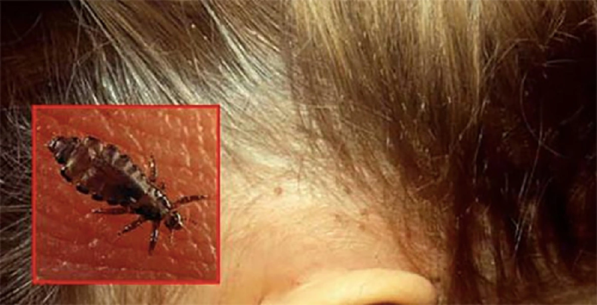 ไม่ต้องรอถึงมือหมอ !! เผย "วิธีรักษาเหา" ที่ได้ผลดีสุดๆ โดยไม่ต้องพึ่งหมอ !!!