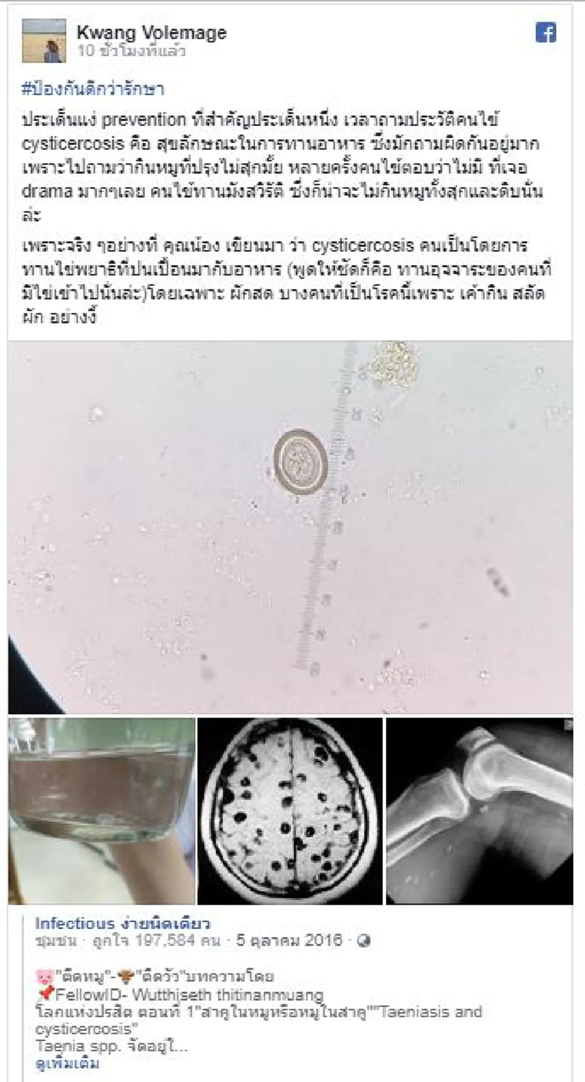 หมอผงะ! จับคนไข้เอกซ์เรย์เจอ "พยาธิตืดหมู" เต็มต้นขา