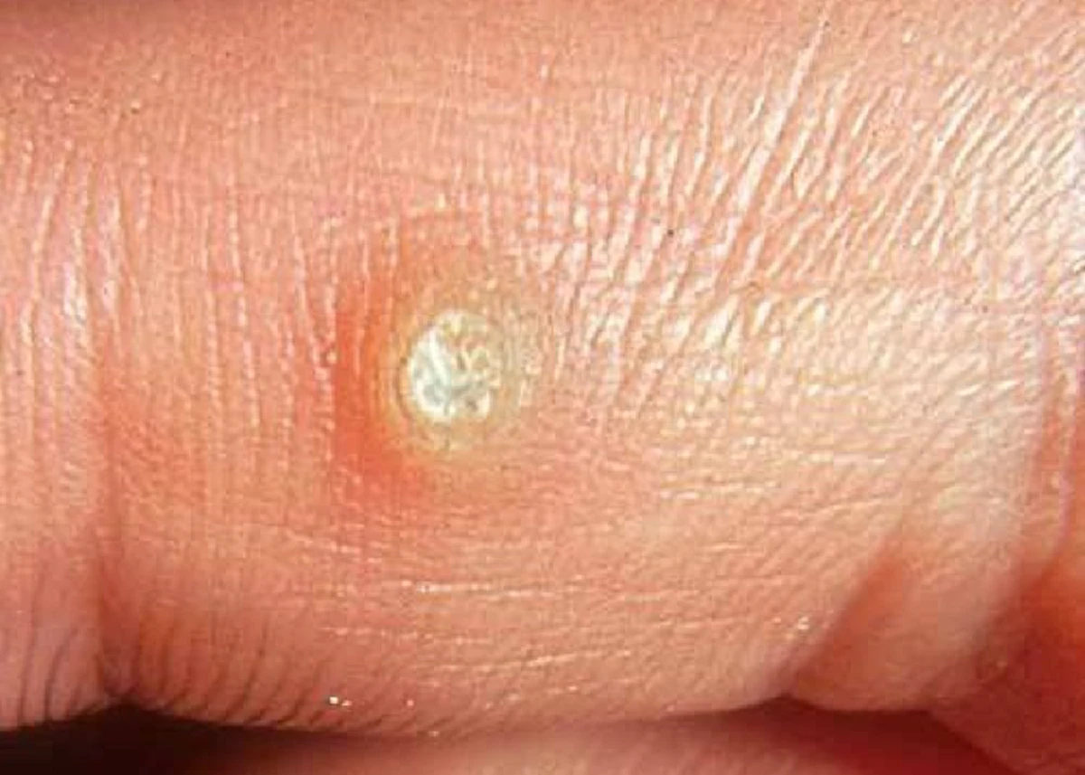 หูด ในร่างกาย