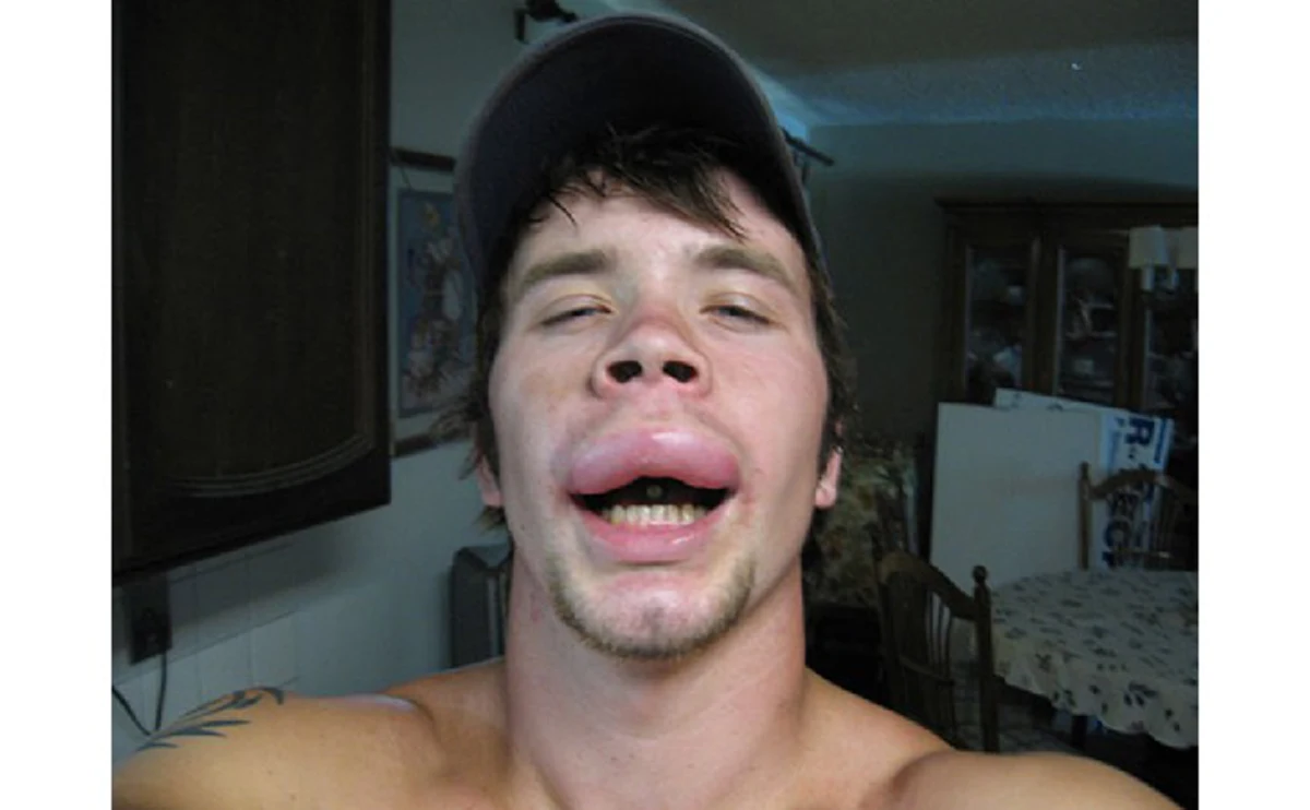 ผึ้งต่อย