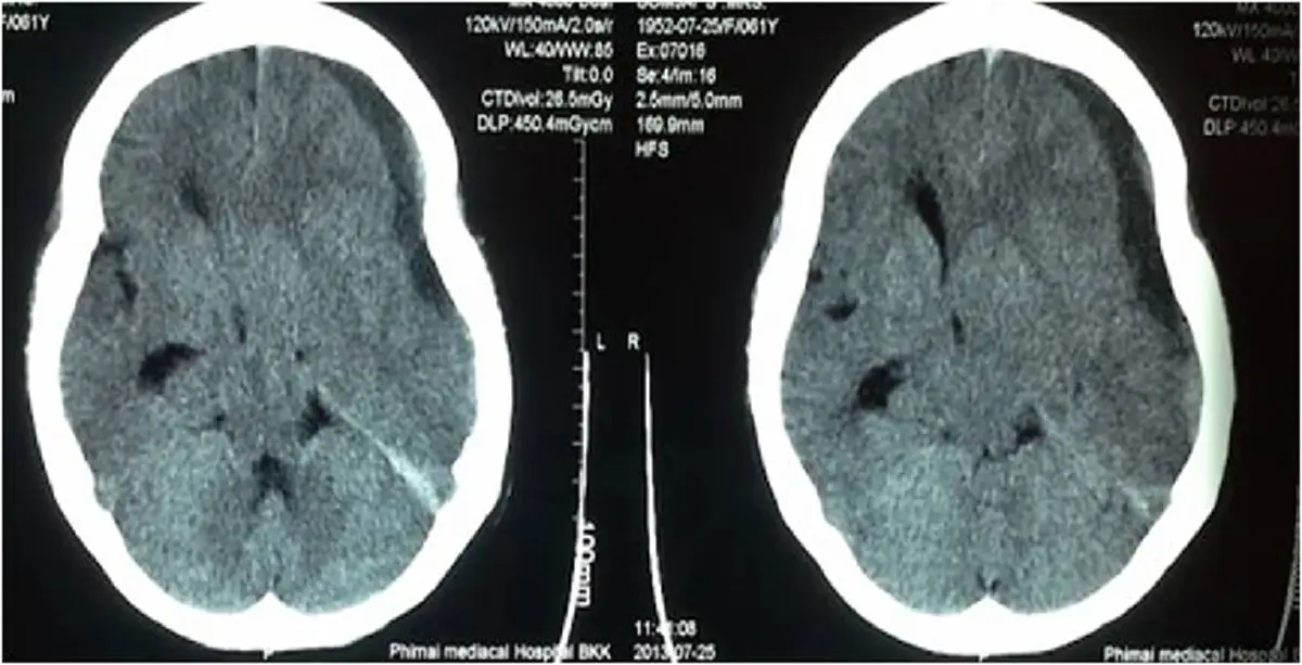 อย่ามองข้าม!!! มะเร็งสมอง ภัยร้ายที่ไม่คาดคิด เป็นแล้วเป็นอีกได้!!!