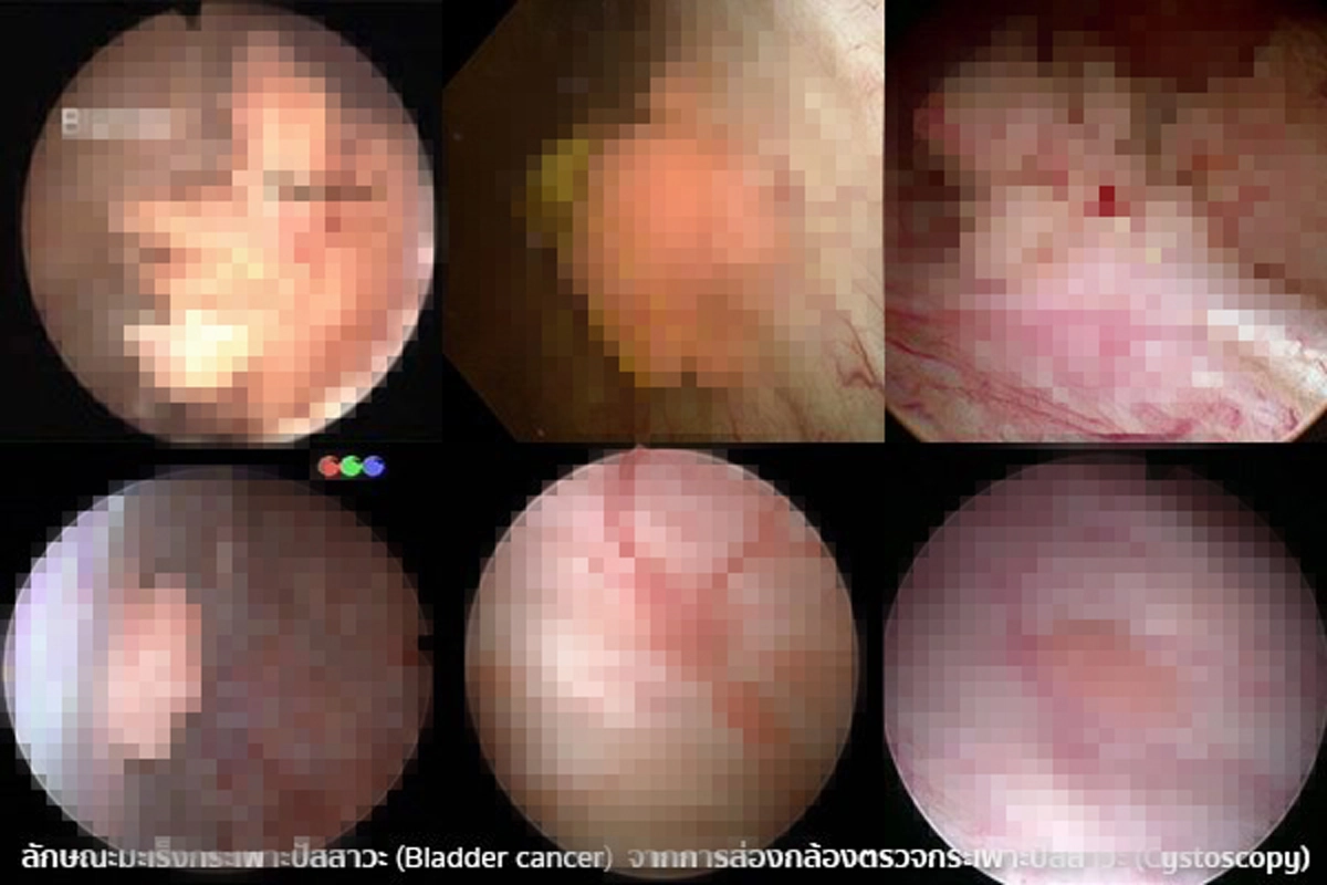 แพทย์ย้ำ!!! มะเร็งกระเพาะปัสสาวะพบบ่อยในไทย ไม่มีปัจจัยเสี่ยงก็เกิดโรคได้!!!