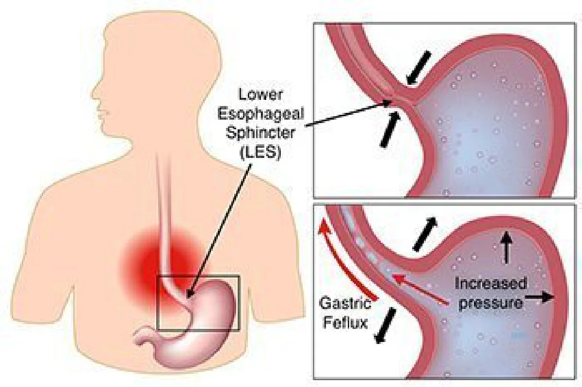 มนุษย์เงินเดือนต้องรู้!!! “โรคกระเพาะกรดไหลย้อน” ภัยเงียบโรคออฟฟิศซินโดรมสำหรับคนทำงานยุคนี้