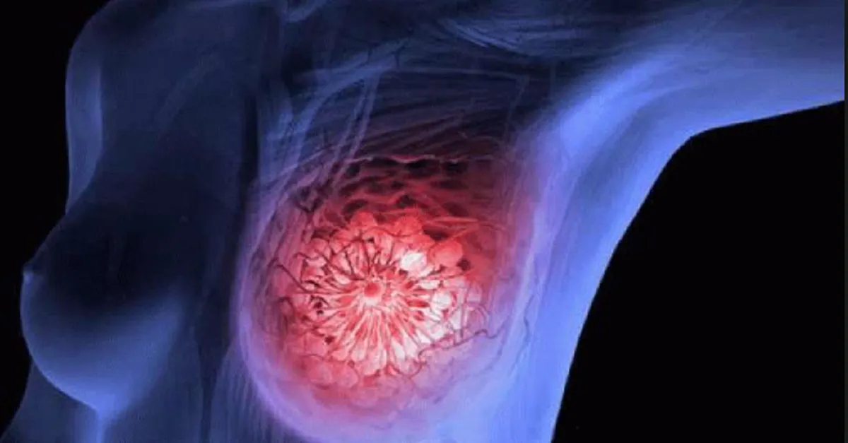 แพทย์เตือน!!! มะเร็งเต้านมเป็นได้ทั้งชายหญิง!!! ไม่อยากเป็นมะเร็งเต้านมต้องอ่าน!!!