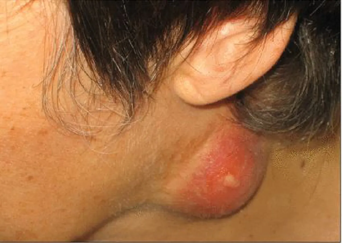 ระวัง!!! พฤติกรรมประจำวันส่งสัญญาณเสี่ยงมะเร็งลำคอโดยไม่รู้ตัว!!!